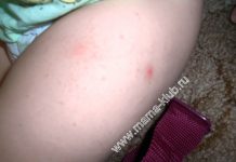 СЫПЬ ПОСЛЕ ПРИВИВКИ АКДС