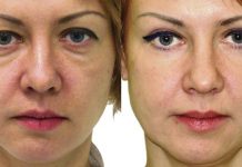 БЛЕФАРОПЛАСТИКА ПЛАСТИЧЕСКИЕ ОПЕРАЦИИ НА ЛИЦЕ