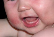 ЭКССУДАТИВЫЙ ДИАТЕЗ У ДЕТЕЙ, ДИАТЕЗ ГРУДНИЧКОВ, ЛЕЧЕНИЕ, МАЗЬ