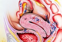 ВСЁ ОБ ЭНДОМЕТРИОЗЕ