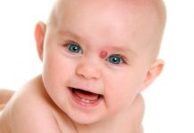 ГЕМАНГИОМЫ ПРОСТЫЕ, ВИДЫ,КАВЕРНОЗНЫЕ И КОМБЕНИРОВАННЫЕ, УДАЛЕНИЕ ГЕМАНГИОМ