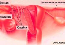 НЕПРОХОДИМОСТЬ МАТОЧНЫХ ТРУБ, СИМПТОМЫ, ЛЕЧЕНИЕ КАК ЗАБЕРЕМЕНЕТЬ,