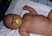 ПУПОЧНАЯ ГРЫЖА У НОВОРОЖДЕННЫХ ДЕТЕЙ, ЛЕЧЕНИЕ